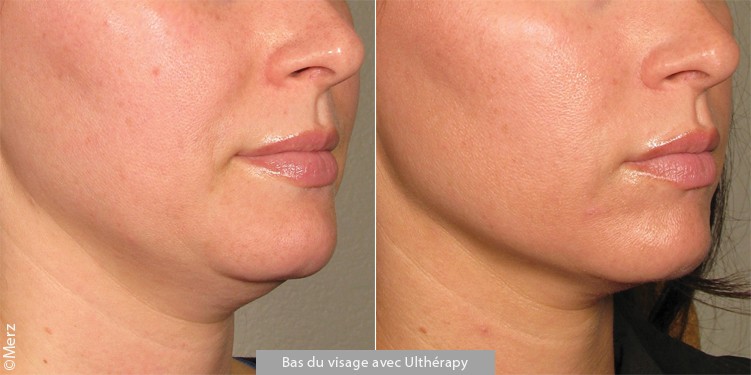 Face contour tightening in Dubai - before after | The Champs-Elysées Clinic