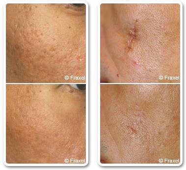 Acne and post operative scars treatments - before after | The Champs-Elysées Clinic