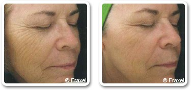 Face wrinkles treatment in Dubai - before after | The Champs-Elysées Clinic