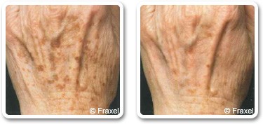 Hands dark spots removal in Dubai | before after | The Champs-Elysées Clinic