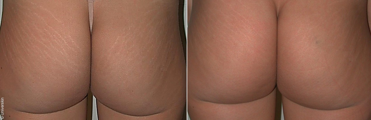 Stretch marks removal with Universkin in Dubai | Champs Elysées medical Clinic
