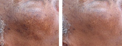 Spot treatment on dark skins in Dubai | Before & After | The Champs-Elysées Clinic