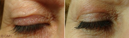 Plexr plasma eye lift in Dubai- Before & After Picture| The Champs Élysées Clinic