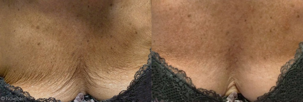 Neck lines treatments in Dubai | Before & After | The Champs-Elysées Clinic