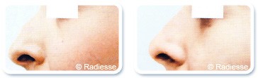 Non Surgical rhinoplasty in Dubai - before after picture | The Champs-Elysées Clinic