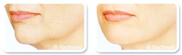 Facial Contouring with Fillers in Dubai - Before & After | The Champs-Elysées Clinic