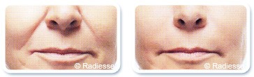 Nasolabial folds filling in Dubai - Before & After | The Champs-Elysées Clinic