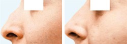 Non Surgical Rhinoplasty in Dubai - Before & After | The Champs-Elysées Clinic