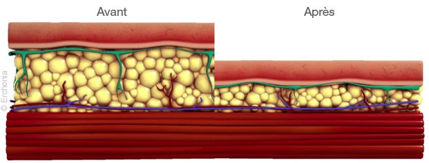 Fat reduction with Verjú in dubai - before after picture - The Champs-Elysées Clinic