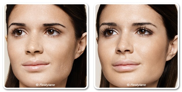 Face skin hydration with Skinbooster - before after | The Champs-Elysées Clinic