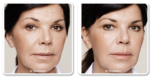 Wrinkles Treatment  with Skin Booster in Dubai - Before & After | The Champs-Elysées Clinic