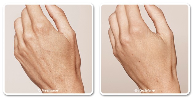 Hand rejuvenation with Skinbooster in Dubai | before after | The Champs-Elysées Clinic