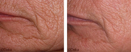 Fine Lines and Wrinkles Removal in Dubai, before after | The Champs-Elysées Clinic