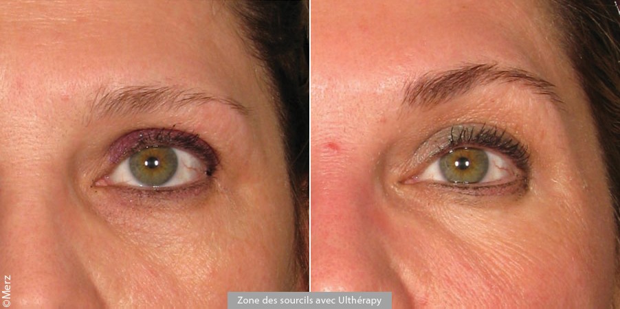 Ultherapy in Dubai - Eyebrow & Eyelid Skin Tightening in Dubai | The Champs-Elysées Clinic