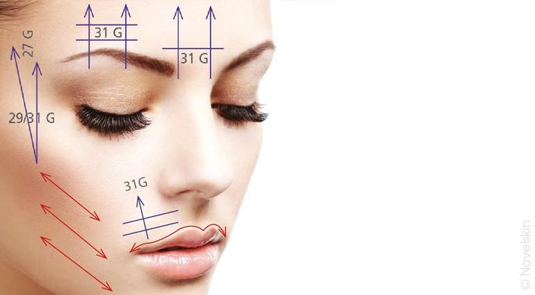 Positioning of the tensor threads on the face and body