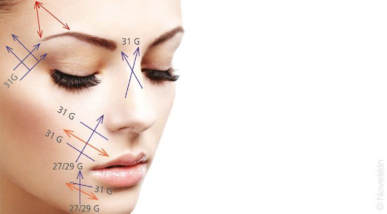 Positioning of the tensor threads on the face and body